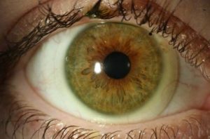 Close up of eye with scleral lenses