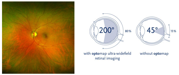 Optos Optomap scan