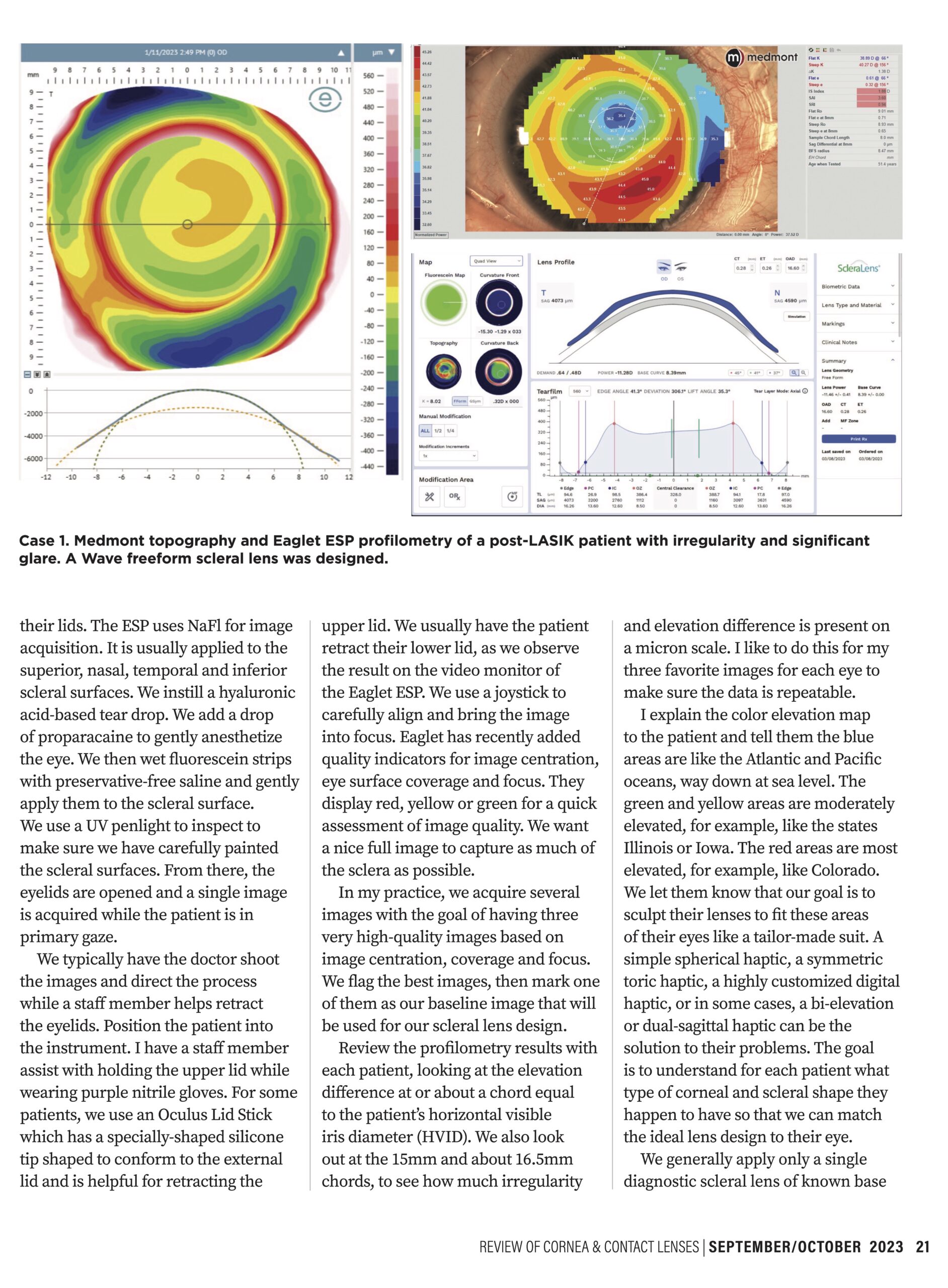 Imaging the Scleral Profile for Enhanced Scleral Lens Results By Joseph DiGiorgio, OD Page 2